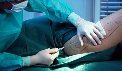 weight loss surgery